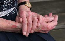 پیشگیری از مشکلات پوستی در سالمندان