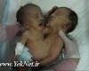 تولد عجیبب دوقلوهای ایرانی با یک قلب+عکس