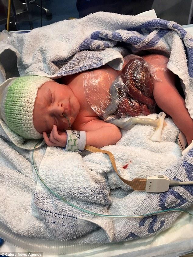 (عکس) تولد نوزادی با روده خارج از بدن