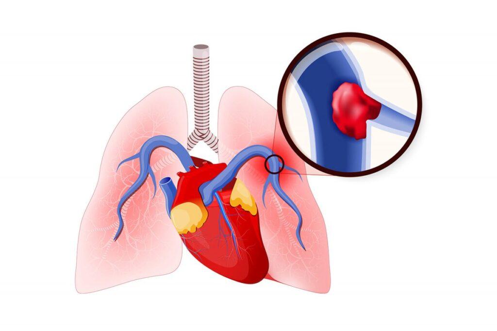 آمبولی ریه چیست