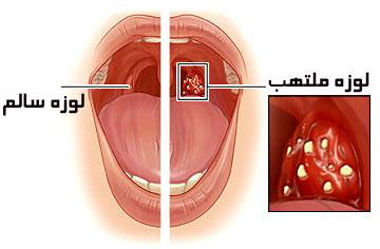 لوزه کودک را چه موقع عمل کنیم؟