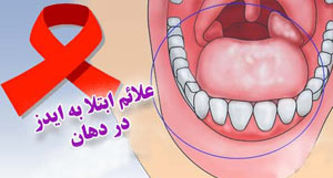 علائم ابتلا به ایدز - ابتلا به ایدز در دهان