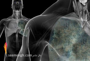 همه چیز درباره سرطان ریه