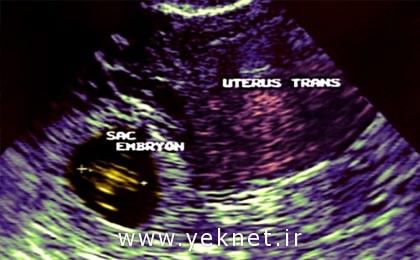 خارج کردن جنین ۳۶ ساله از بدن مادر ۶۰ ساله /عكس
