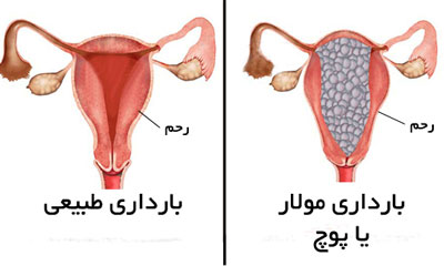 حاملگی مولار یا پوچ چیست؟
