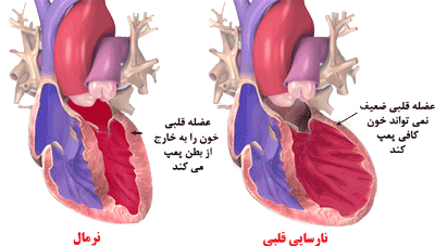 علائم و نشانه های نارسایی تریکوسپید