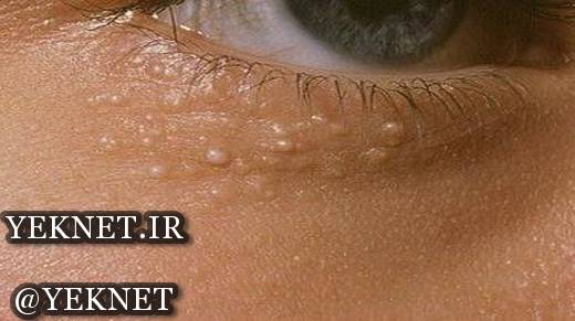 علت بروز و درمان دانههای چربی سفید رنگ زیر چشم