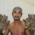 (عکس) مرد درختی بنگلادشی جراحی شد