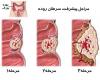 علائم سرطان روده بزرگ