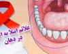 علائم ابتلا به ایدز - ابتلا به ایدز در دهان 