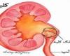 اگر ميخواهيد سنگ كليه بگيريد نمك و گوشت قرمز بخوريد
