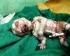 تولد یک نوزاد با چهره وحشتناك در ايران +عكس