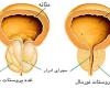آشنایی با نشانه ها وعلایم سرطان پروستات