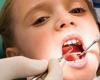  درمان پوسیدگی دندان شیری چیست؟