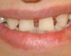 ﻿روش درمان فاصله بین دندان ها