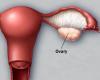 علل و عوارض برداشتن تخمدان زنان