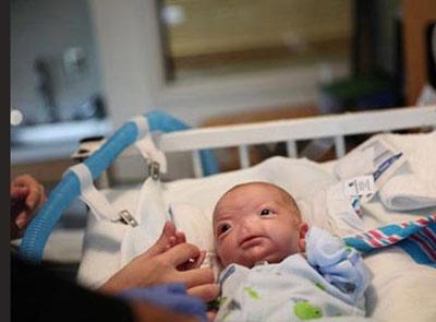تولد یک نوزاد بدون بینی (تصاویر)