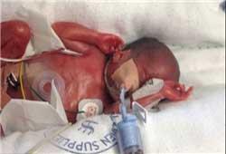 کوچک‌ترین نوزاد متولد شده در دنیا+عکس