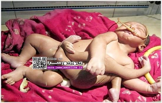 تولد نوزادي با 4 دست و 4 پا  +عكس