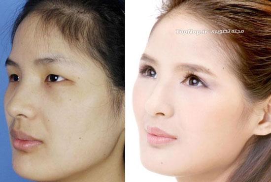 دختران چيني قبل و بعد از جراحي زيبايي