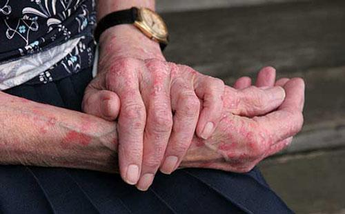 پیشگیری از مشکلات پوستی در سالمندان